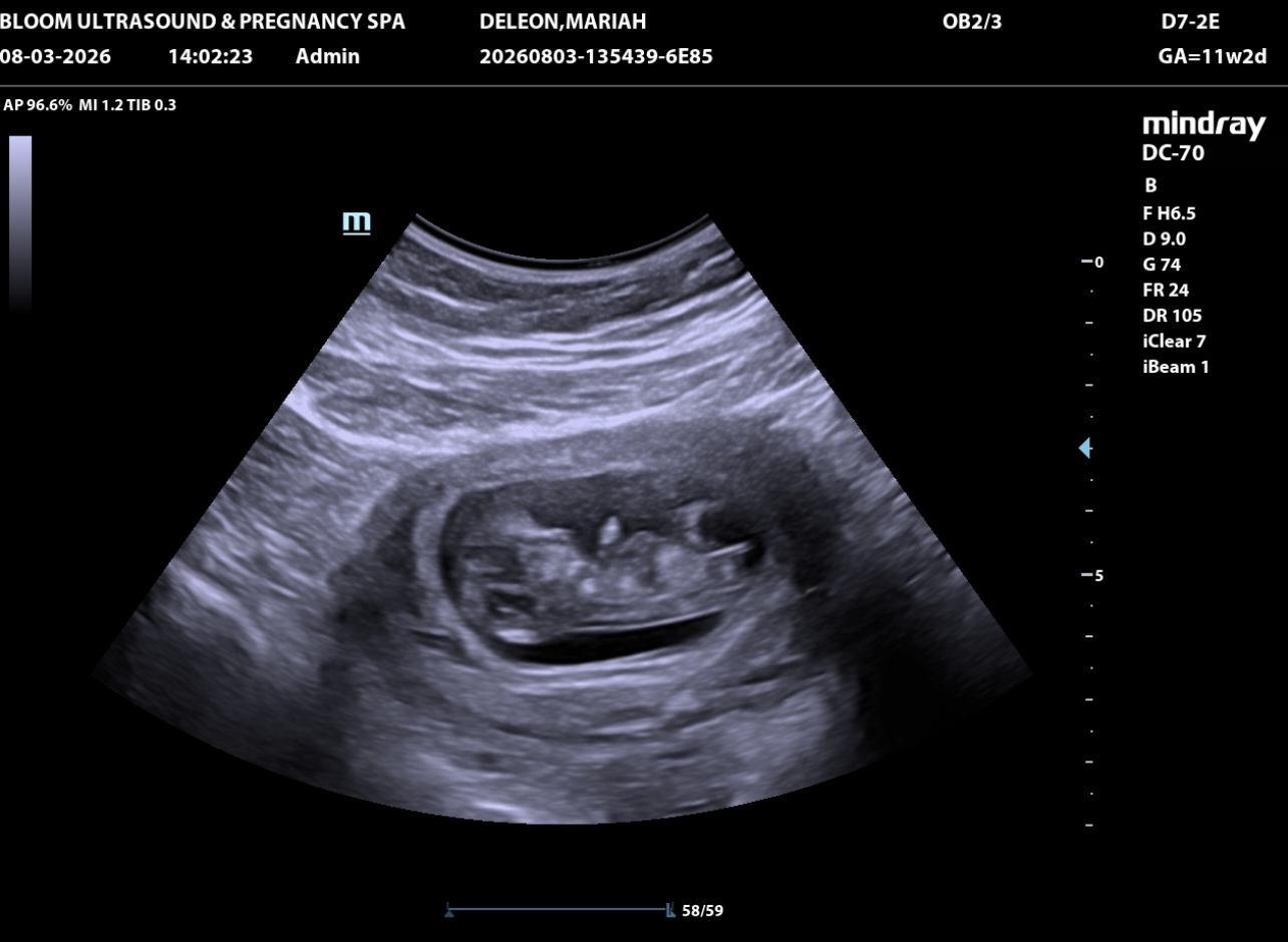 This is an ultrasound photo of my baby